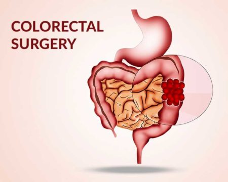 5 Things You Should Know Before Colorectal Surgery