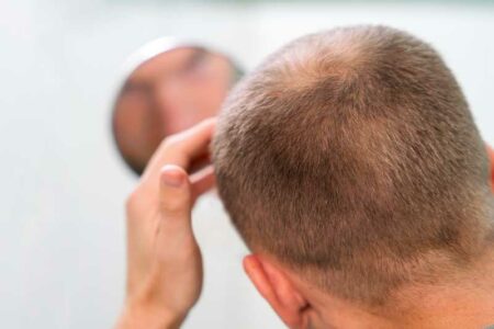 Men and Hair Loss Should You Use A Hair Replacement