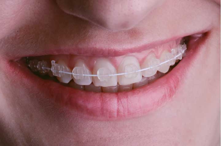 What Are the Different Types of Braces