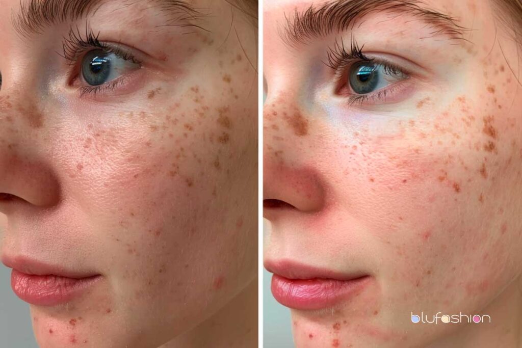 Close-up before-and-after comparison of facial skin treatment showing marked improvement in clarity and reduction of blemishes.